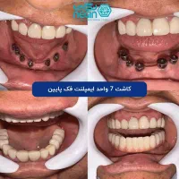 ایمپلنت دیجیتال اقساطی بدون سود در انواع برندها|خدمات آرایشگری و زیبایی|شیراز, زرگری|دیوار