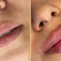 جشنواره ژل و بوتاکس