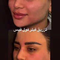 ۳۰٪تخفیف ژل بوتاکس مصپورت لیزر هایفو غبغب در مطب