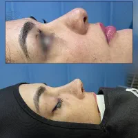 رینوپلاستی با جراح متخصص اف ویژه
