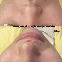 فیشال و جوانسازی پوست|خدمات آرایشگری و زیبایی|قائمشهر, |دیوار