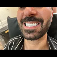 دندان مصنوعی طرح لمینت ونیر