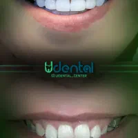 کامپوزیت، لمینت، ایمپلنت اقساط ویژه|خدمات آرایشگری و زیبایی|ری, شهرری|دیوار