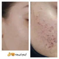 رفع ریزش مو و رویش مجدد،رفع جوش وجای جوش