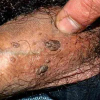 رفع سریع منقوله های زگیل ریشه ای