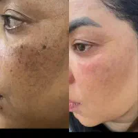 برداشتن لک دونه ای ۴۰ هزار تومان.