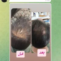 تونیک تقویت ورشد مو،ضد ریزش مو