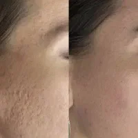 میکرونیدلینگ و مزوتراپی تخصصی