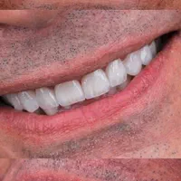 کامپوزیت فیسینگ ارتودنسی بزرگسالان و کودکان بیهوشی|خدمات آرایشگری و زیبایی|شیراز, زرگری|دیوار
