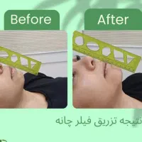 جشنواره ویژه هایفو تراپی بوتاکس ژل لب گونه|خدمات آرایشگری و زیبایی|تهران, نارمک|دیوار