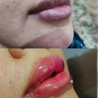 تزریق ژل بوتاکس چال گونه تتو پرسینگ مژه و اموزش|خدمات آرایشگری و زیبایی|اهواز, معین زاده|دیوار