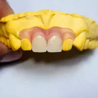 دندانسازی مصنوعی تکه ای (پارسیِل)هرفک تا ۵ دندان