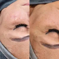 لیزر و فشیال