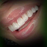 کامپوزیت، لمینت، ایمپلنت اقساط ویژه|خدمات آرایشگری و زیبایی|تاکستان, |دیوار