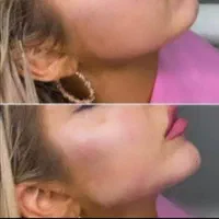 نیازمند مدل بوتاکس و ژل.اموزش ژل و بوتاکس|خدمات آرایشگری و زیبایی|صدرا-فارس, فاز ۱|دیوار