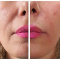 تخفیفات ویژه پی آر اف(PRF) پی ار پی|خدمات زیبایی و سلامت|شیراز, چوگیاه|دیوار