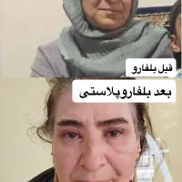 بلفاروپلاستی ، ژل ، بوتاکس|خدمات زیبایی و سلامت|تبریز, |دیوار