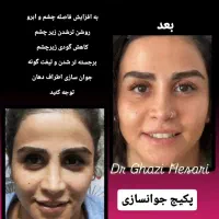 لیزر تزریق بوتاکس ژل فیلر مزوتراپی هایفو توسط پزشک