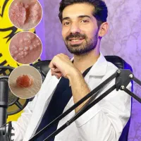 درمان قطعی و بدون بازگشت زگیل hpv