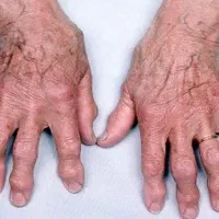 درمانگر بیماری روماتیسم و درد مفاصل|خدمات آرایشگری و زیبایی|اصفهان, شهرک سلامت|دیوار