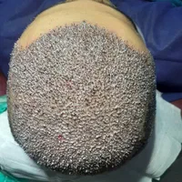تخفیف ویژه تابستانه کاشتمو،ریش وسبیل وابرو