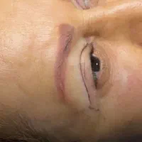 جراحی بلفاروپلاستی مشاوره رایگان