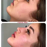 تزریق ژل و بوتاکس|خدمات آرایشگری و زیبایی|اهواز, کوروش|دیوار