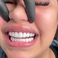 کامپوزیت دندان