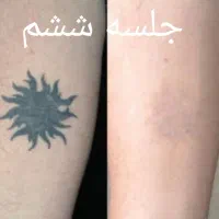 لیزر پاک کردن تتو بشکل مدرن|خدمات آرایشگری و زیبایی|اهواز, فرهنگ شهر|دیوار