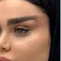 بوتاکس ۴۹۰ ، لیفت با نخ ۲/۸۰۰ ، لیفت فرم دهی بینی