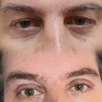 جراحی زیبایی پلک(بلفاروپلاستی) توسط چشم پزشک