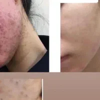 پاکسازی وفیشیال تخصصی پوست خانمهاوآقایون|خدمات آرایشگری و زیبایی|بهبهان, |دیوار