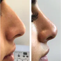 تزریق آنزیم و فیلر بینی