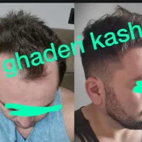 جشنواره‌کاشت مو و ابرو و ریش و‌سبیل