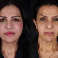 خدمات زیبایی هر سی سی فیلر ۸۵۰|خدمات آرایشگری و زیبایی|اصفهان, تیران|دیوار