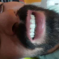 عصبکشی پر کردن ۱۳۰۰ روکش فروش رادیوگرافی|خدمات آرایشگری و زیبایی|مرند, |دیوار