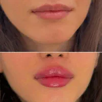 جشنواره ۵۰ درصدی ژل بوتاکس فقط تا سه روز|خدمات آرایشگری و زیبایی|اصفهان, برازنده|دیوار