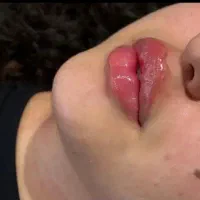 تزریق فیلر درجه 1 تضمینی  سی سی یه تومن