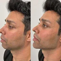 تزریق ژل و بوتاکس طراحی چهره برای زیبایی‌خاص|خدمات آرایشگری و زیبایی|تهران, شادمان|دیوار