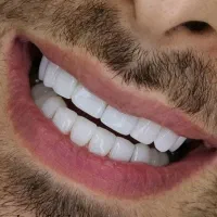 کامپوزیت و ایمپلنت