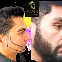 آموزش کاشت مو و ریش و ابرو با گروه شیرازی