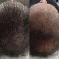کم پشتی موهات با میکرواسکالپ، کبودی لبات با شیدینگ|خدمات آرایشگری و زیبایی|کاشان, مفتح|دیوار