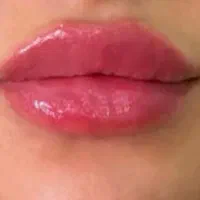 تزریق ژل وبوتاکس|خدمات آرایشگری و زیبایی|شیراز, ریشمک|دیوار
