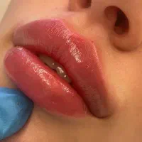 تخفیف ویژه تزریق فیلر و جوانساز تا پایان ماه