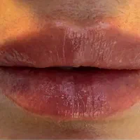 فیلر و مزوژل به صورت اقساطی|خدمات زیبایی و سلامت|تهران, شهران جنوبی|دیوار