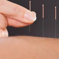 حجامت طبی سوزنی امبدینگ زالودرمانی زگیل تناسلیhpv|خدمات آرایشگری و زیبایی|اصفهان, بهارستان (مخابرات)|دیوار