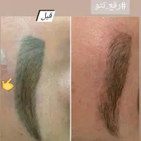 پاک کردن انواع تتو و روشن کردن نواحی تیره|خدمات آرایشگری و زیبایی|رشت, منظریه|دیوار