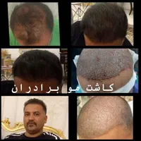 کاشت مو و ابرو در تبریز، پیش پرداخت ۶میلیون|خدمات آرایشگری و زیبایی|اردبیل, |دیوار