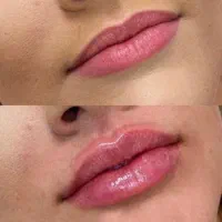 تخفیف تزریق بوتاکس و ژل