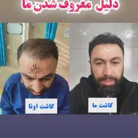 کاشت مو تضمینی با سابقه ده ساله